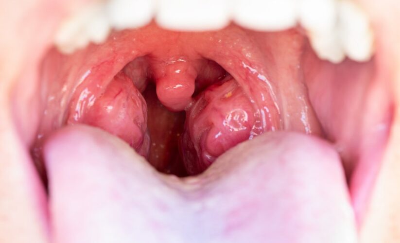 Effective Ways to Get Rid of Tonsil Stones at Home: Proven Tips for 2025