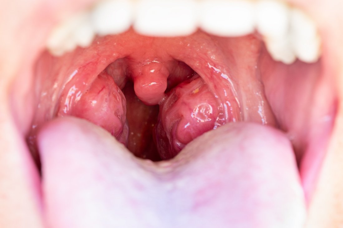 Effective Ways to Get Rid of Tonsil Stones at Home: Proven Tips for 2025