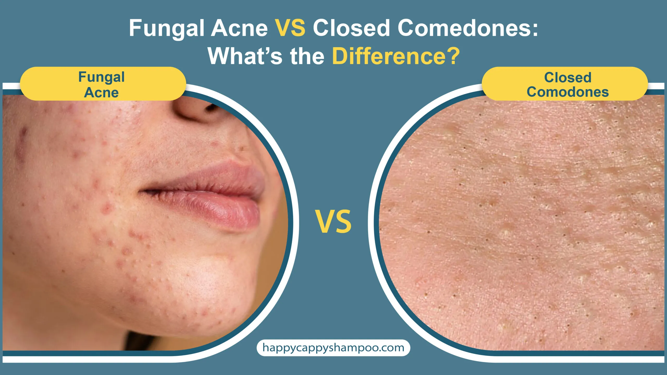 Effective Ways to Get Rid of Fungal Acne in 2025: Proven Solutions for Clear Skin