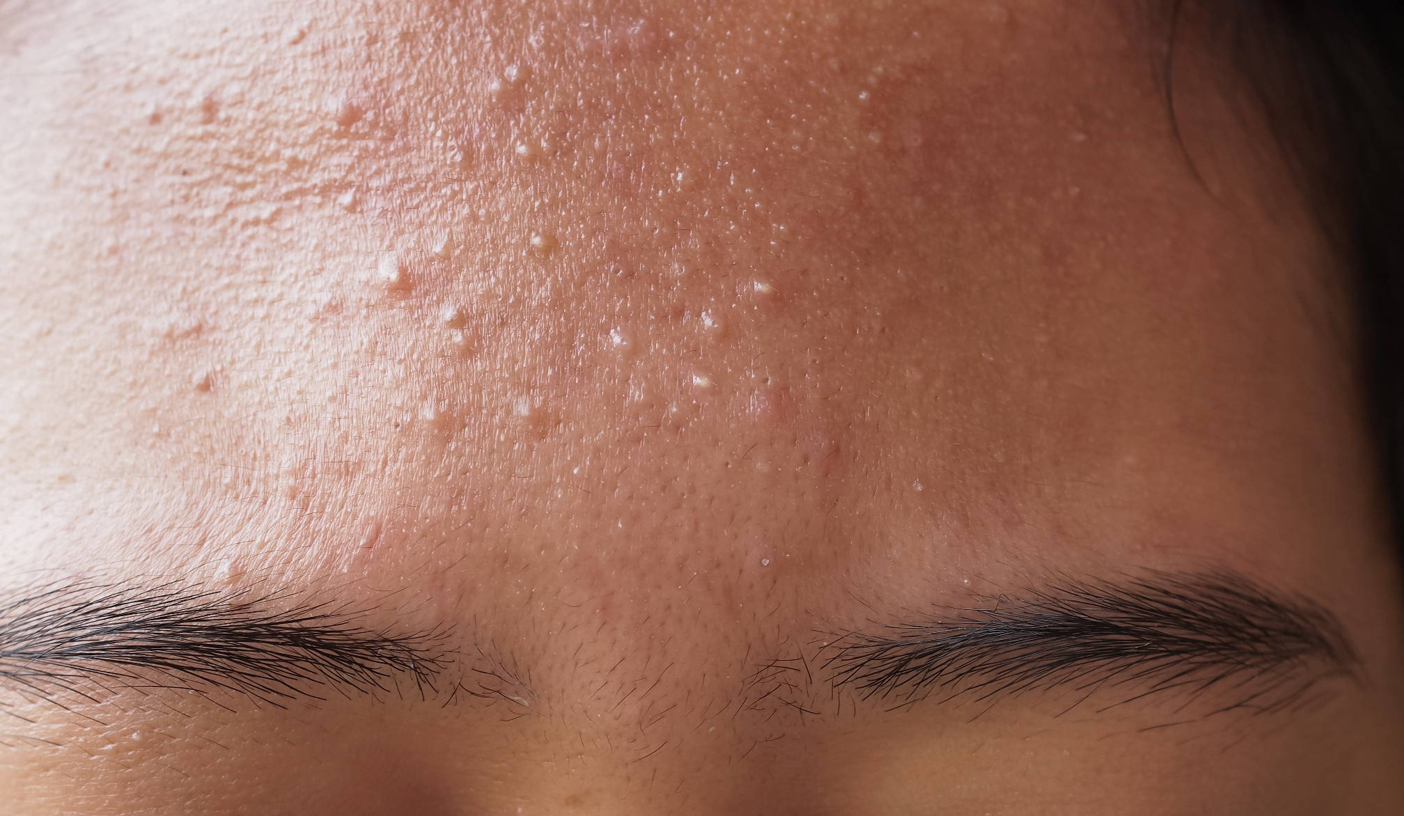 Tips for treating fungal acne