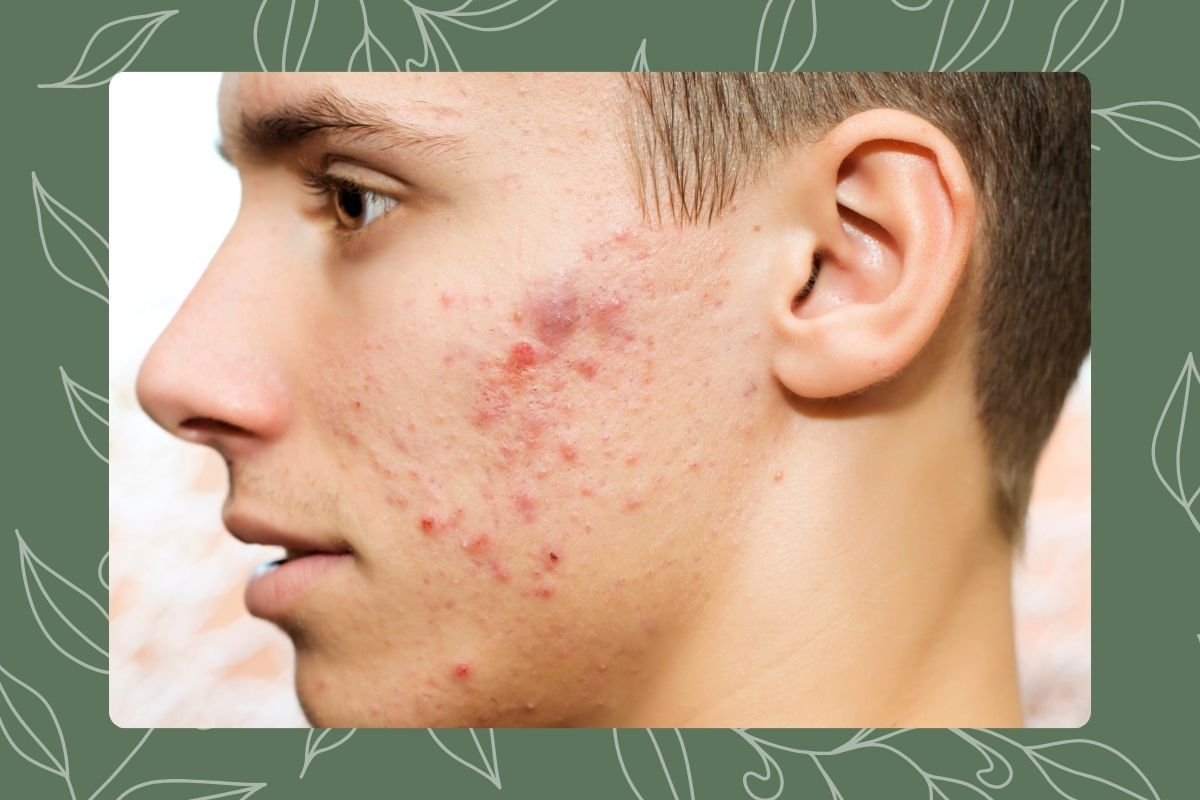 Natural solutions for fungal acne