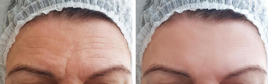 Effective Treatments for Forehead Wrinkles